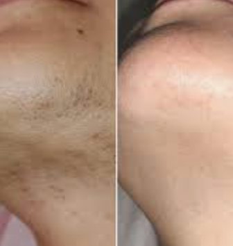 Olio Depilatorio – Specifico per peli da PCOS, per una pelle naturalmente liscia
