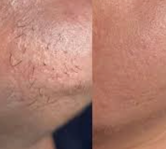 Olio Depilatorio – Specifico per peli da PCOS, per una pelle naturalmente liscia