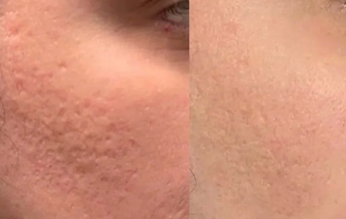 Velora Microcrystal™ Sérum Nuit Duo | Une peau plus lisse en seulement 3 à 5 nuits
